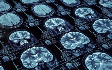 Alzheimer hastalığı