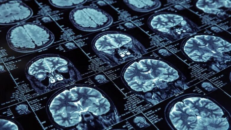 Alzheimer hastalığı